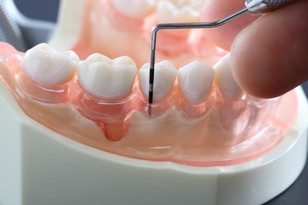 歯周病<br><small>periodontics</small>